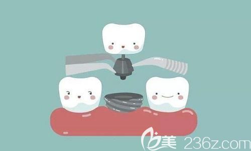 种植牙 种植牙