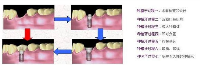 种植牙二期手术过程 种植牙二期手术过程