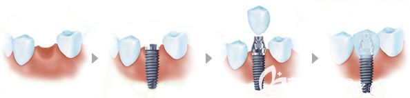 种植牙过程卡通示意图 种植牙过程卡通示意图