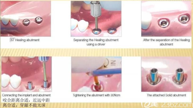 种植牙的过程 种植牙的过程