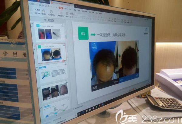 给顾客展示植发效果的专业案例 给顾客展示植发效果的专业案例