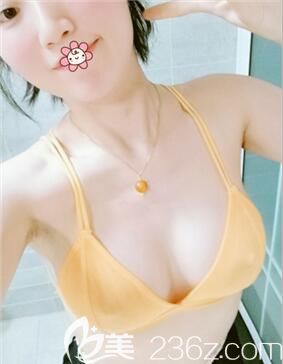 220cc曼托假体胸对我这种个子160cm的人来说大小刚合适！