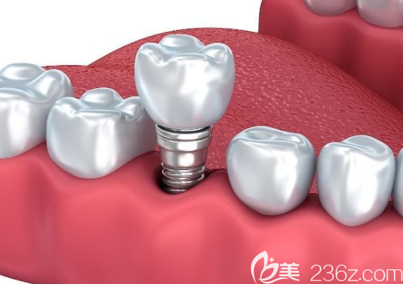种植牙 种植牙