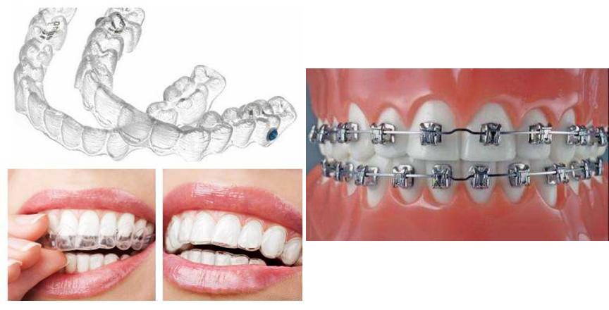 牙齿矫正的方式方法 牙齿矫正的方式方法