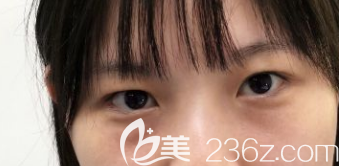 去眼袋手术前的样子 去眼袋手术前的样子