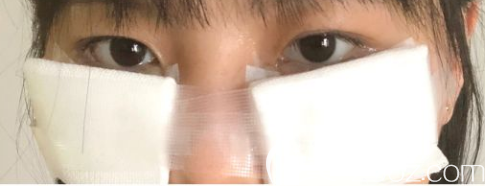 去眼袋手术后的第二天 去眼袋手术后的第二天