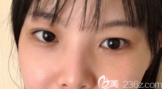 护肤品祛眼袋已经五六年了没有用然后去做了内切去眼袋