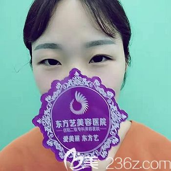 做双眼皮前眼睛的状态 做双眼皮前眼睛的状态