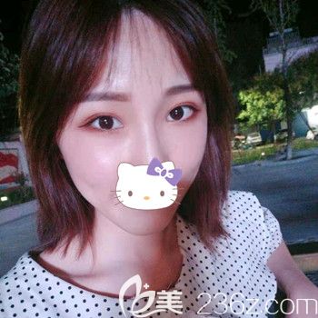 割双眼皮40天后的状态 割双眼皮40天后的状态