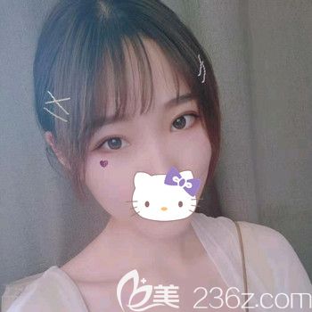 割7毫米双眼皮二个月恢复后的实际宽度刚刚好