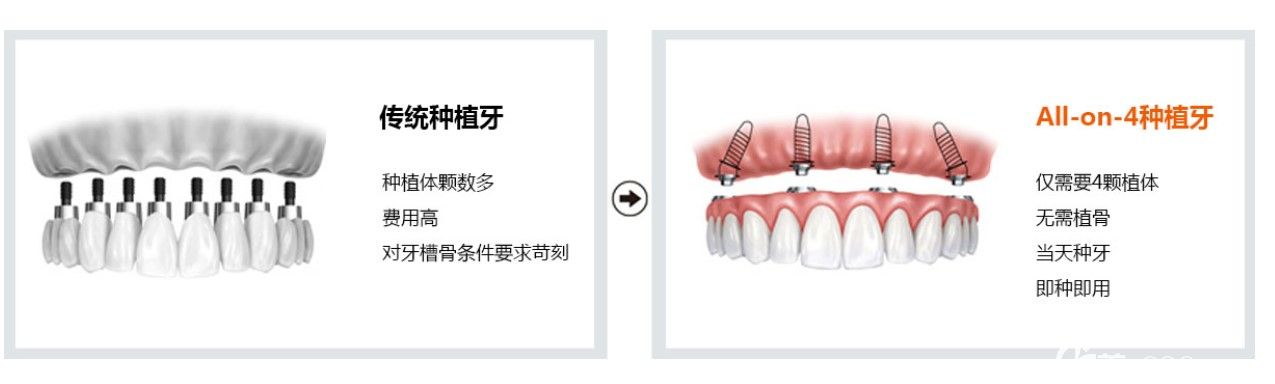 all-on-4即刻种植牙技术 all-on-4即刻种植牙技术