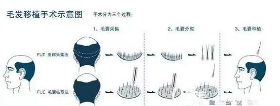 毛发移植手术示意图