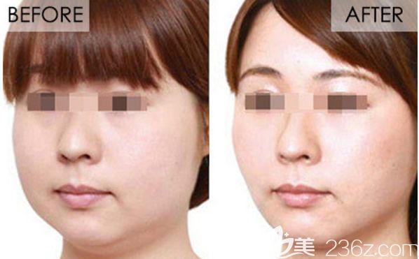 注射轮廓针前后效果对比