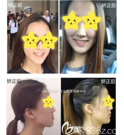 隐适美牙套拔牙矫正毕业啦，经历2次正畸，我有话要说