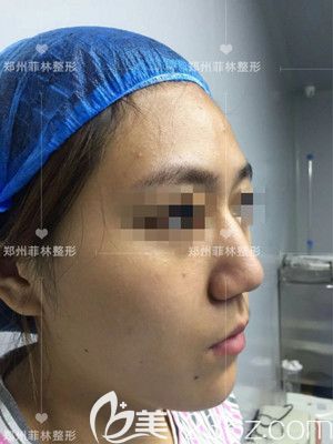 驼峰鼻手术前照片 驼峰鼻手术前照片