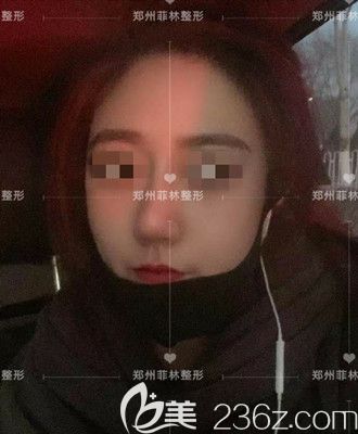 驼峰鼻矫正手术后一个月 驼峰鼻矫正手术后一个月