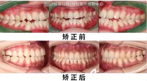 北京瑞鲨口腔隐适美隐形矫正真人案例 北京瑞鲨口腔隐适美隐形矫正真人案例