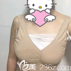 自体脂肪隆胸初次术后 自体脂肪隆胸初次术后