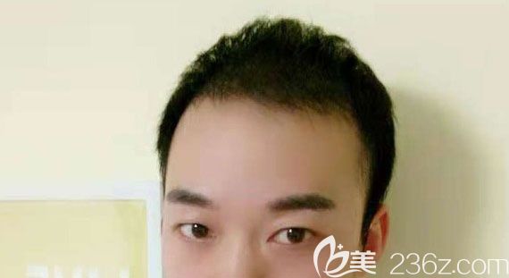 打听到该医院植发团队技术比较好，我专程到北京做了2000毛囊单位的头顶加密种植