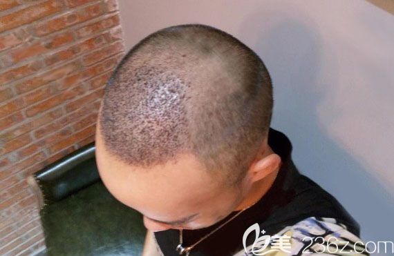 清洗血痂的时候一定要轻柔不能抠