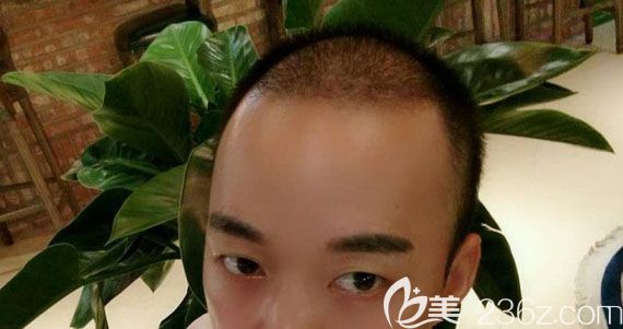 头顶加密种植术后一个月<span style=