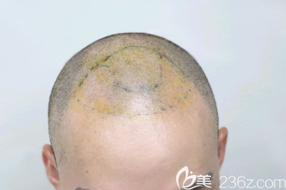 术前画线设计制定植发方案