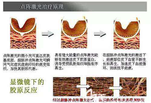 点阵激光治疗痤疮