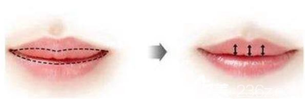 厚唇改薄术原理
