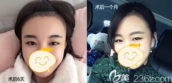 刚做完发际线种植，头顶的小毛茬很可爱