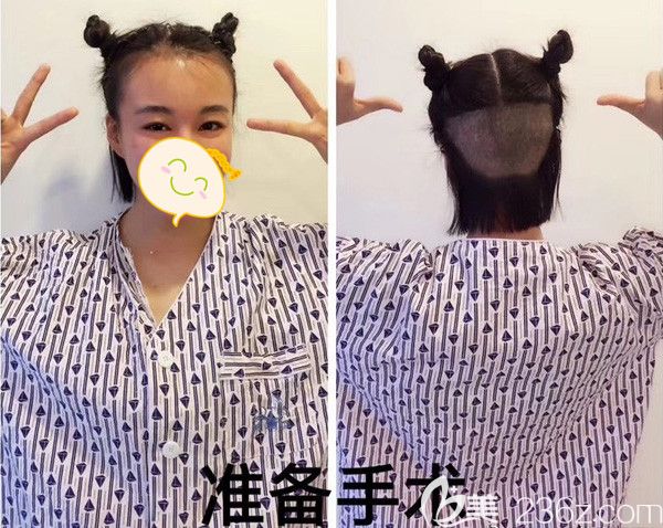 精神满满的我要去植发啦