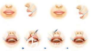 厚唇改薄手术过程图