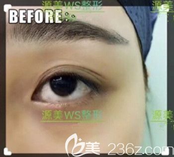 术前眼皮松弛眼睛没有精神 术前眼皮松弛眼睛没有精神