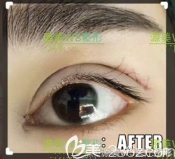 割双眼皮的时候是否需要开内眼角 割双眼皮的时候是否需要开内眼角