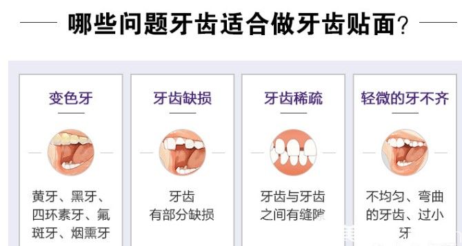 哪些牙齿可以做牙齿贴面