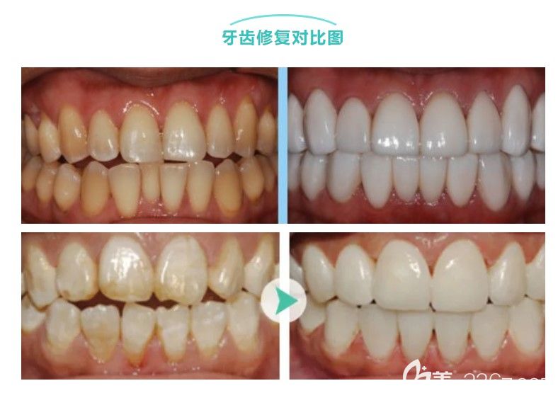 牙齿贴面的费用