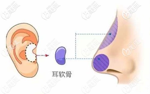 耳软骨隆鼻的手术原理