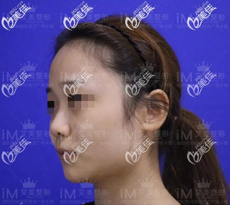 隆鼻手术前 隆鼻手术前