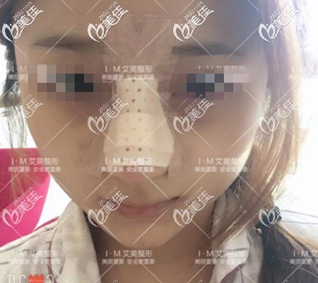 鼻综合术后第二天 鼻综合术后第二天