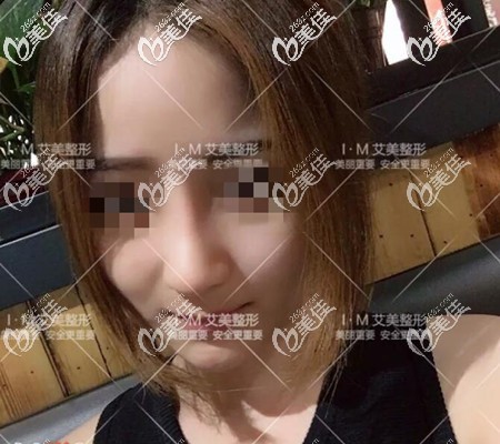 鼻综合拆线后 鼻综合拆线后