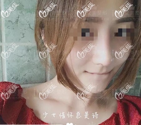 虽然鼻综合恢复期很痛苦，但7天拆线后的隆鼻变化真的美到我了