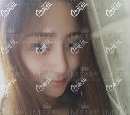 鼻综合术后半年恢复效果 鼻综合术后半年恢复效果