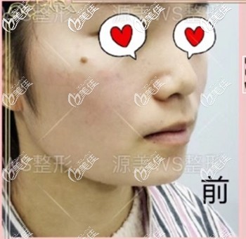 玻尿酸填充下巴前的样子 玻尿酸填充下巴前的样子