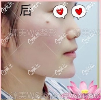 微整初体验：用2支海薇大分子玻尿酸丰下巴后从当天的图片中就能看出变化