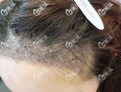 发际线刚种上去的毛囊 发际线刚种上去的毛囊