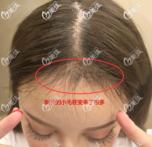 植发际线4个月后的头发长了很多 植发际线4个月后的头发长了很多