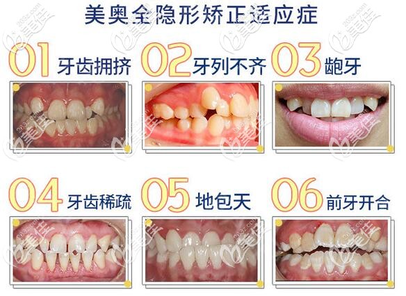 重庆美奥口腔全隐形牙齿矫正 重庆美奥口腔全隐形牙齿矫正