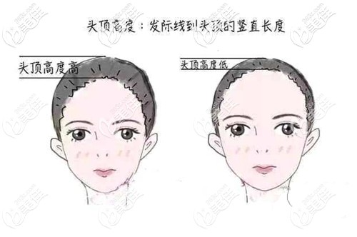 女士发际线种植设计方案 女士发际线种植设计方案