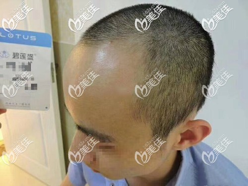 术前两侧额角脱发缺失 术前两侧额角脱发缺失