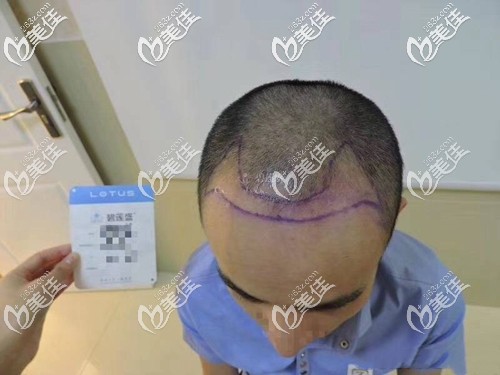 医生为我设计种植区域 医生为我设计种植区域