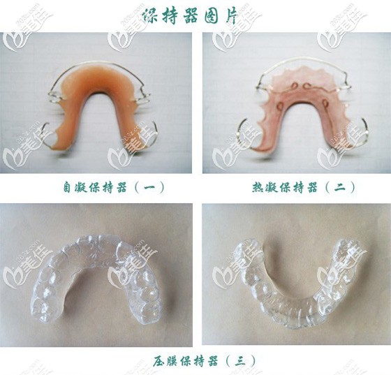 沈阳米兰口腔彭阳医生介绍保持器的种类 沈阳米兰口腔彭阳医生介绍保持器的种类
